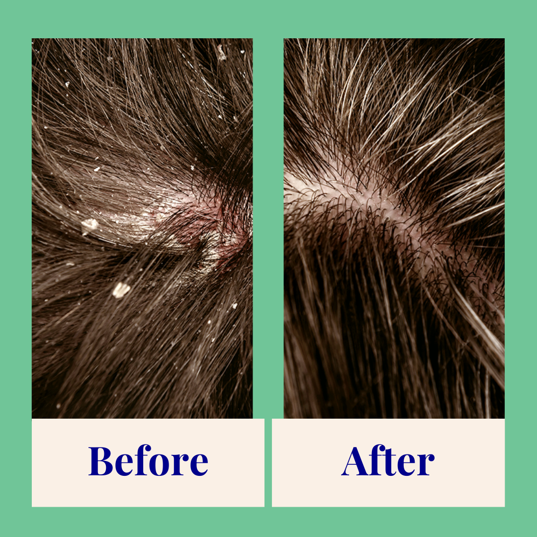 Exfoliating Powder Shampoo For Anti-Dandruff Scalp Refill pack)